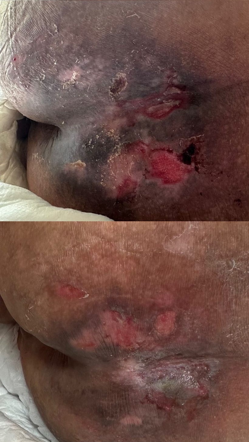 Caso real de cicatrização de ferida acompanhado pela RAC VitalCure — antes e depois