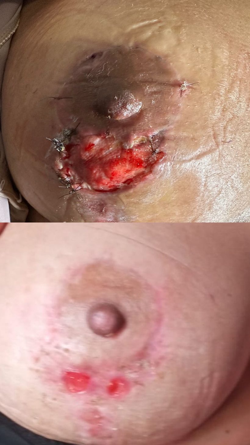 Caso real de cicatrização de ferida acompanhado pela RAC VitalCure — antes e depois