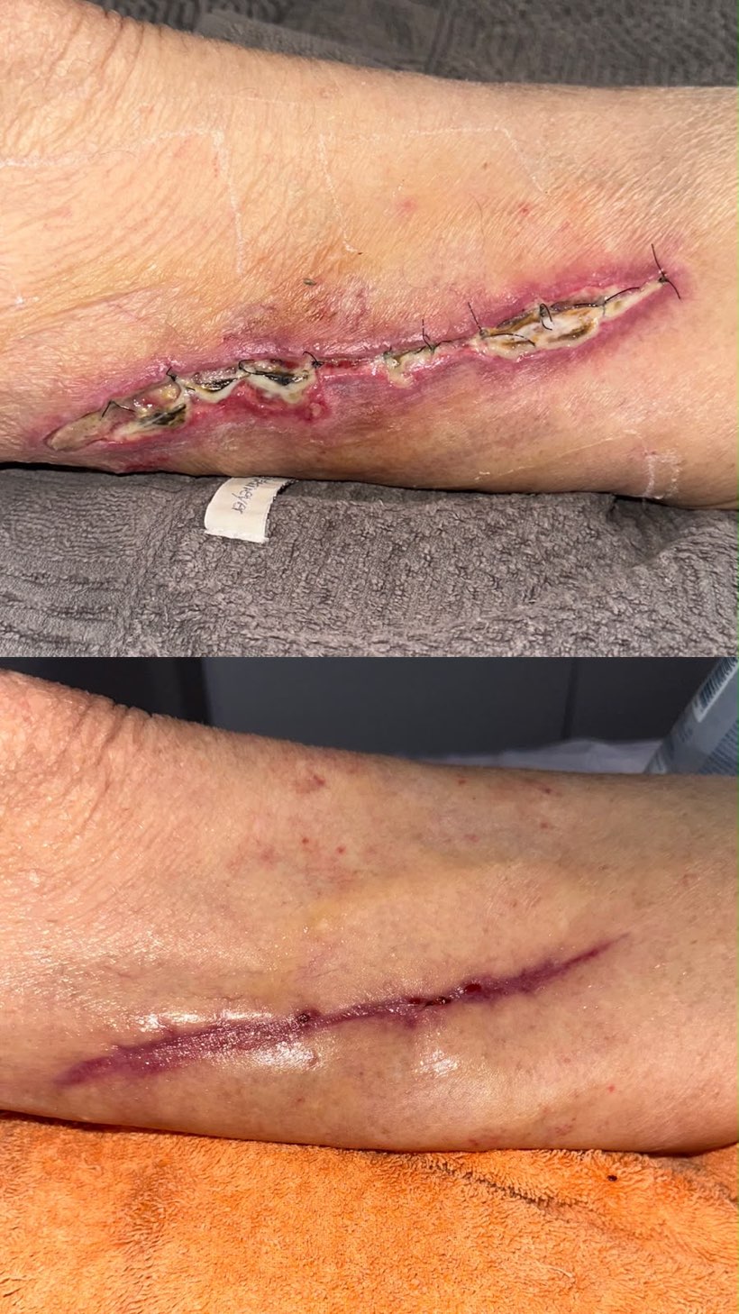 Caso real de cicatrização de ferida acompanhado pela RAC VitalCure — antes e depois